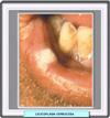 Leucoplasia verrucosa