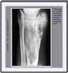 Radiografía de la tibia