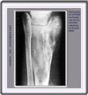 Radiografa de la tibia