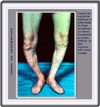 Imagen clínica mostrando el acortamiento de una pierna