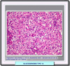 Histología hepática en la enfermedad de von Gierke