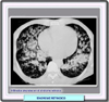 Infiltrados pulmonares en el sndrome de cido retinoico
