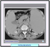 Tomografa Computarizada de una esplenomegalia