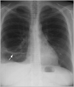 Radiogradia de una embolia pulminar