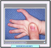 Pulgar trifalángico en el Síndrome de Aase-Smith