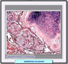 Histopatología de ujn hamartoma pulmonar
