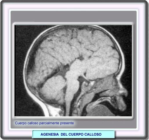 agenesia del corpo calloso causes agenesia del corpo calloso causes