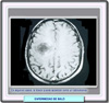Resonancia magntica en un caso de enfermedad de Balo