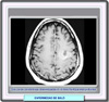 Resonancia magntica en un caso de enfermedad de Balo