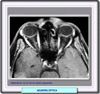 neuritis óptica