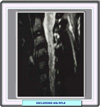 Esclerosis múltiple en la médula