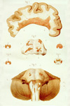 Ilustracin de Charcot