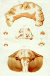 Ilustración de Charcot