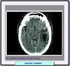 Resonancia de un absceso cerebral