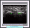 Ecografa del neuroma de Morton