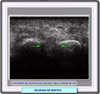 Ecografa del neuroma de Morton