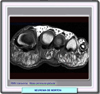 Resonancia del neuroma de Morton