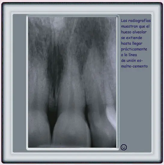 Radiografia de una enca sana