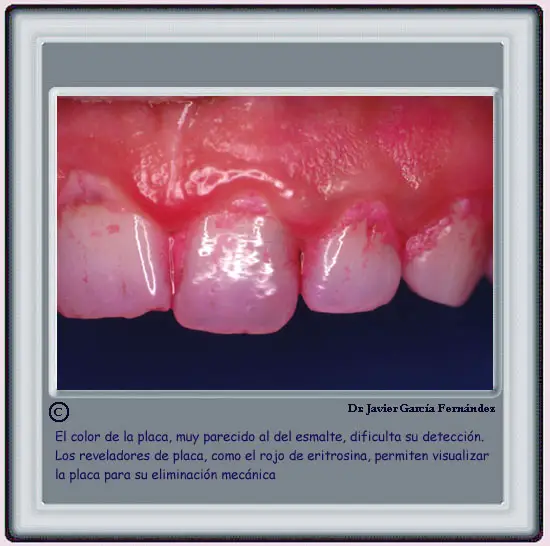 Placa  teida con eritrosina