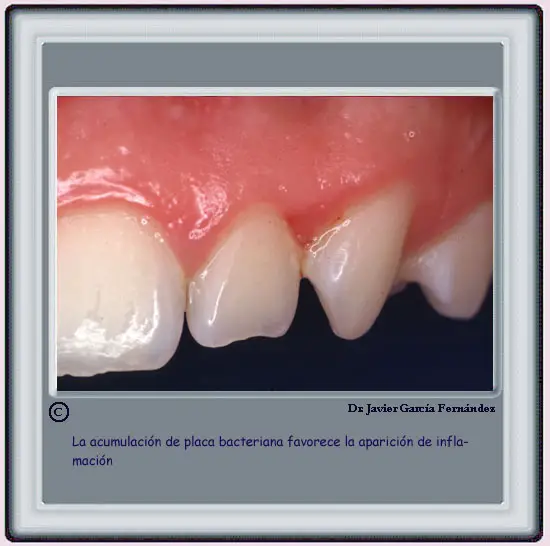 Acumulacin de Placa Bacteriana