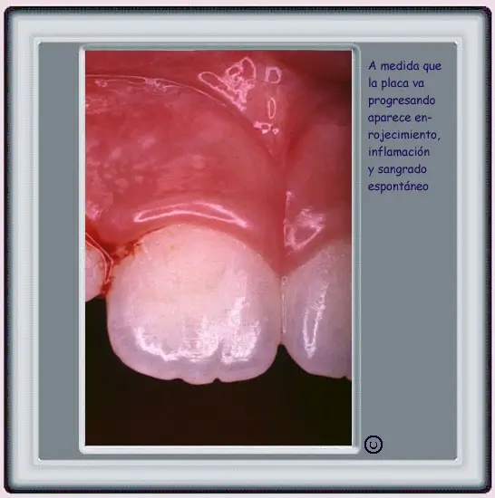 Progreso de la Placa