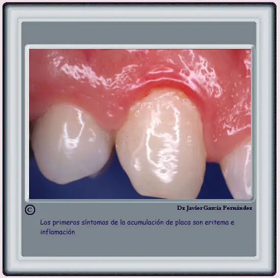 Eritema e inflamacin 