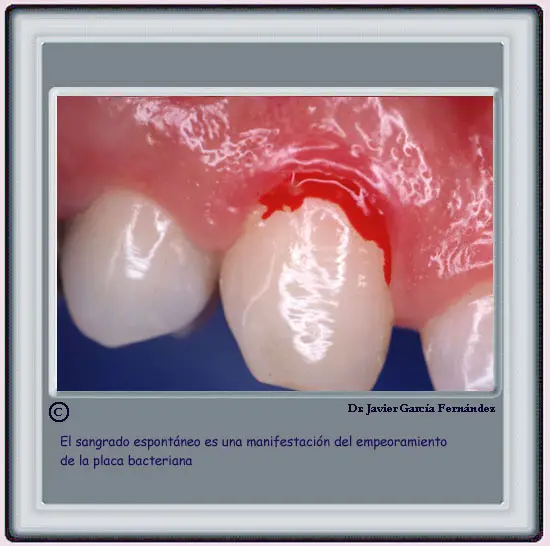 Sangrado espontneo