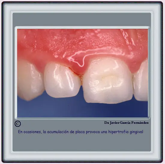 hipertrofia gingival por acumulacin de placa