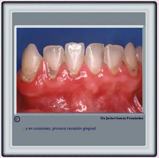 Recesin Gingival por acumulacin de placa