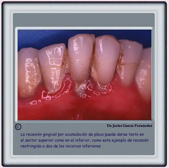 Recesin gingival por acumulacin de placa