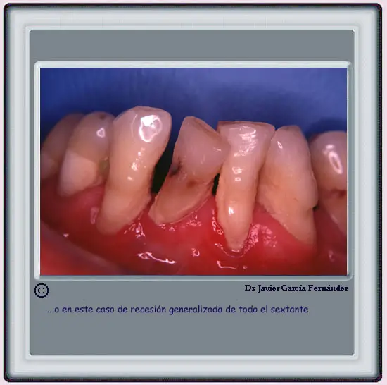 Recesin generalizada en todo el sextante