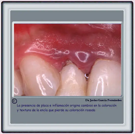 Cambio de textura de la enca