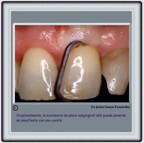 Observacin de placa con la cureta