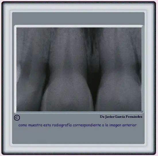 Radiografa de una encia sana