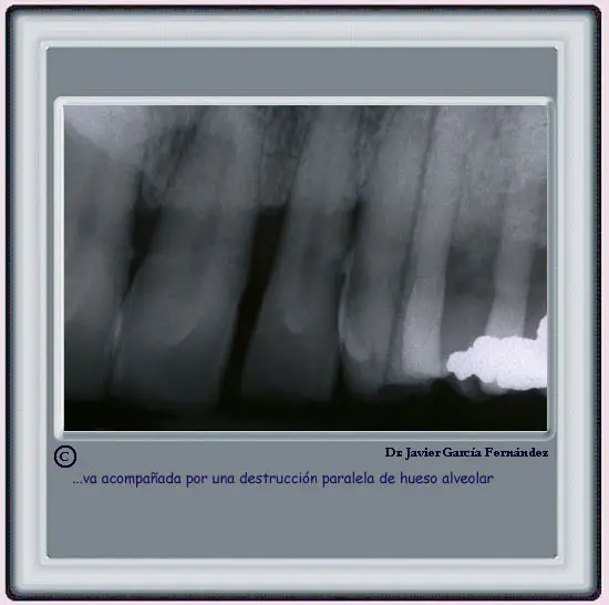 Radiografa mostrando prdida de hueso