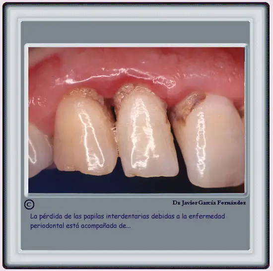 Prdida de papilas interdentarias