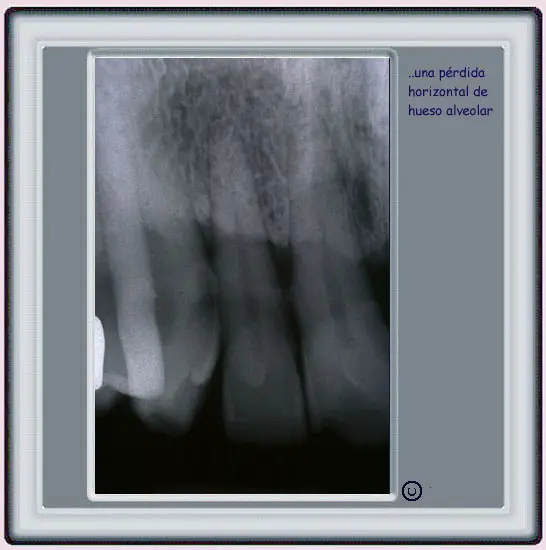 Radiografa mostrando prdida de hueso