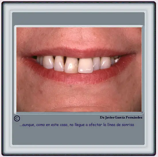 Recesin que no afecta la lnea de la sonrisa