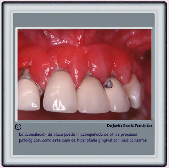 Acumulacin de Placa e hiperplasia por medicamentos