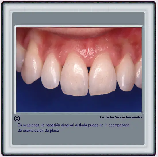 Recesin gingival sin placa