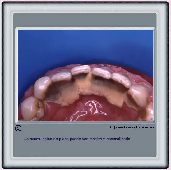 Acumulacin de placa generalizada