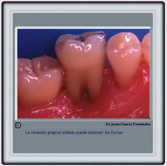 Recesin que alcanza las furcas