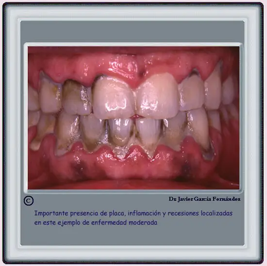 Presencia de placa y recesiones