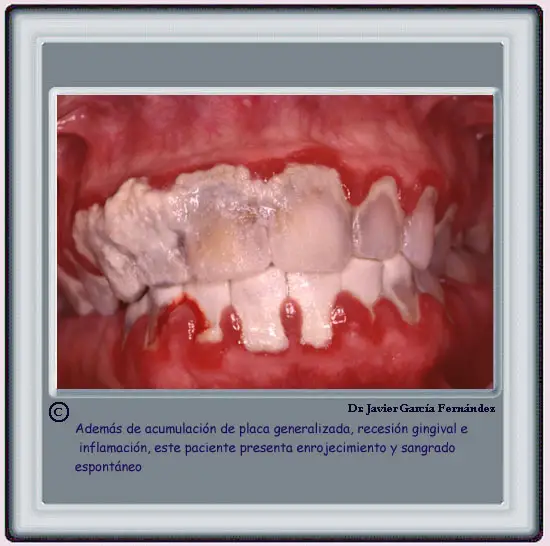 Acumulaci�n generalizada de placa