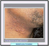 Seudofoliculitis