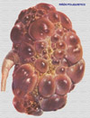 Imagen patológica de un riñón poliquistico